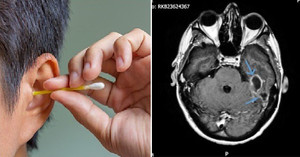 Ngoáy tai bằng tăm bông, người đàn ông bị nhiễm trùng não nguy hiểm chết người