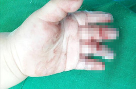 Cháu bé 16 tháng tuổi bị máy xay thịt nghiền nát bàn tay