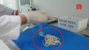 Clip: Kinh hãi gắp sán dây dài 5,2 mét trong người cô gái