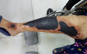 Bị hoại tử chân do đắp cao lá vối chữa bỏng