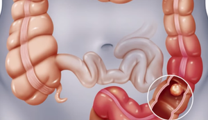 Bác sỹ lôi cả lạng măng tươi ra khỏi ruột bệnh nhân