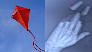 Người đàn ông mất 3 ngón tay vì thả diều