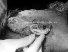 Bé trai 6 tuổi được tạo hình tai sớm bằng kỹ thuật mới, cực khó