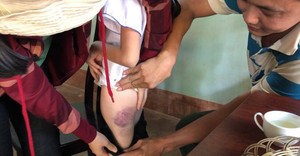 Cô giáo ở Đắk Lắk đánh học sinh lớp 4 bầm tím người: Phòng Giáo dục và Đào tạo lên tiếng