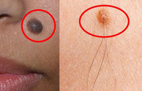 Có phải cứ nốt ruồi mọc lông là bị ung thư?