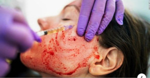 Chuyên gia chỉ rõ lý do bị lây nhiễm HIV từ lăn kim, dùng huyết tương khi làm đẹp