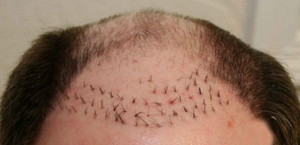 Cấy tóc chữa hói đầu lấy lại vẻ nam tính, người đàn ông 39 tuổi thiệt mạng