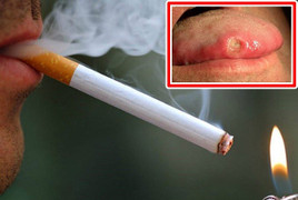 Cô gái 23 tuổi phải cắt bỏ 1/2 lưỡi, bác sĩ cảnh báo người trẻ đang mắc căn bệnh đáng sợ