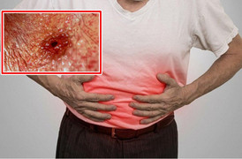 Những dấu hiệu tố cáo bị ung thư dạ dày cần ghi nhớ