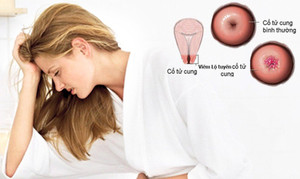 Những bệnh phụ khoa nguy hiểm chết người