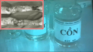 Đắp thuốc nam chữa bỏng cồn, bé 9 tuổi nhập viện khẩn cấp