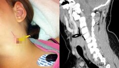 Ngã tại trường, bé 11 tuổi bị bút chì đâm ngang cổ phải nhập viện khẩn cấp