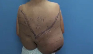 Cứu người phụ nữ 'cõng' khối u khổng lồ 12kg