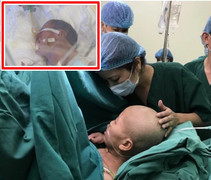 Tại sao sản phụ bị ung thư giai đoạn cuối phải đẻ mổ ở tư thế ngồi?