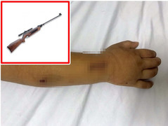 Đang chơi với bạn, bé trai 5 tuổi vô tình bị trúng đạn súng hơi