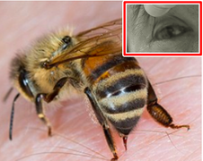 Người đàn ông 51 tuổi ở Quảng Nam suýt mù do bị ong đốt