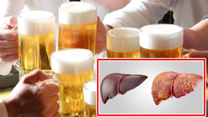 Những tổn thương gan phải 'gánh' nếu sử dụng quá nhiều bia rượu