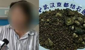 Nhịn ăn sáng nhiều năm, bụng người phụ nữ chứa 7.750 viên sỏi mật