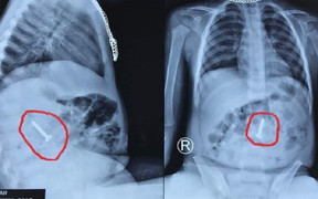 Đinh vít 3,5 cm trong bụng bé 20 tháng tuổi