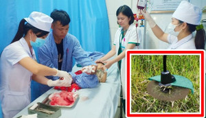 2 giờ cấp cứu căng thẳng cho bé gái 2 tuổi bị máy cắt cỏ chém vào chân