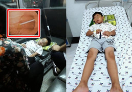 Ngủ quên, bé trai 7 tuổi ở Long An nuốt cả que nhựa kẹo mút vào họng
