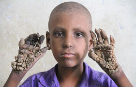 Cuộc sống bế tắc của những người bị 'mọc rễ cây'