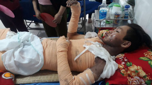 Bé trai 15 tuổi đi làm thuê bị điện giật bỏng 70% ở Đắk Lắk