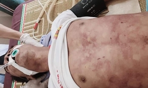 Thịt lợn chết liên hoan, một người đàn ông nhiễm liên cầu khuẩn thiệt mạng