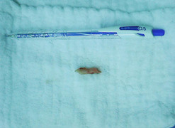 Quái lạ, ăn cháo vịt lại bị hóc xương lợn