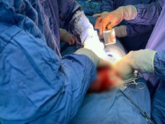 'Bóc' khối u xơ 4,5kg trong tử cung người phụ nữ 60 tuổi