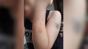 Cô dâu Việt nói không tha thứ, muốn chồng Hàn bị trừng phạt vì hành động vũ phu