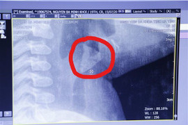 Ăn cháo hầm xương, bé trai 19 tháng tuổi suýt mất mạng