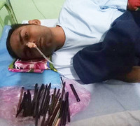 Chàng trai nuốt hàng chục dao, lưỡi lam và tuốc nơ vít vào bụng