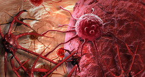 Giám đốc Bệnh viện K lý giải vì sao ung thư ở Việt Nam tăng nhanh