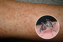 Bệnh nhi đầu tiên ở Đắk Lắk thiệt mạng do sốt xuất huyết