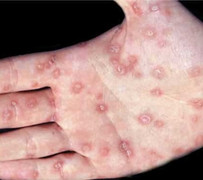 Quan hệ đồng giới và bị lạm dụng tình dục, bé trai 13 tuổi mắc bệnh giang mai