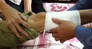 Thiếu hiểu biết đắp thuốc nam chữa gãy chân, người đàn ông gặp biến chứng nặng