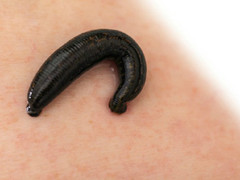 Đỉa còn sống trong cổ họng bé trai 12 tuổi ở Yên Bái