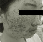 Dùng bột rửa mặt mua trên mạng, mặt thiếu nữ 22 tuổi chi chít mụn nước