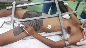 Bé trai bị hàng rào sắt đâm xuyên ngực