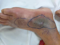 Đang đi bộ, người đàn ông Hà Tĩnh bị rắn độc cắn hoại tử chân