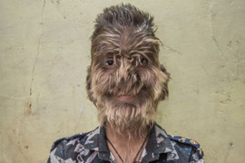 Uống nhầm thuốc, nhiều trẻ em Tây Ban Nha mắc 'hội chứng người sói'