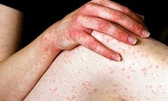 Dị ứng theo mùa và những thực phẩm cần tránh nếu không muốn bệnh trầm trọng hơn