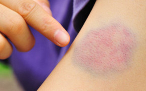 10 dấu hiệu ung thư sớm nhiều người thường chủ quan