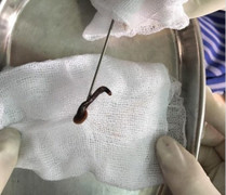 Con đỉa dài gần 8cm sống trong khí quản bé trai