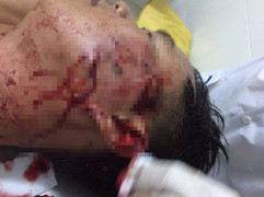 Đại úy Công an ở Sóc Trăng bị đánh thương tích trong quán nhậu