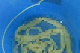 Sán xơ mít dài 7m ký sinh hai năm trong cơ thể người đàn ông