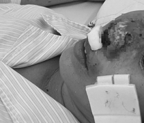 Người phụ nữ ở Hà Nội bị 'vi khuẩn ăn thịt người' ăn mũi