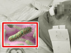 Dấu hiệu nhận biết Whitmore - bệnh 'ăn' mũi có thể gây chết người sau 48 tiếng