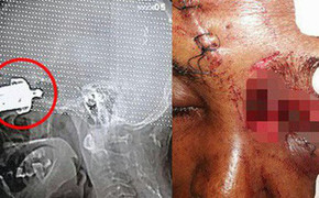 Người phụ nữ bị mù mắt khi dùng nồi áp suất trên bếp gas